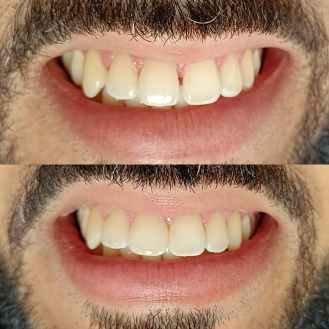 Alinhamento do Sorriso — antes e depois